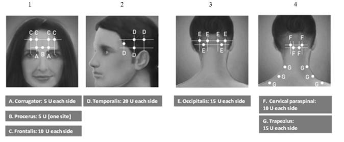 Diagrams 1-4: Recommended Injection Sites (A through G) for Chronic Migraine