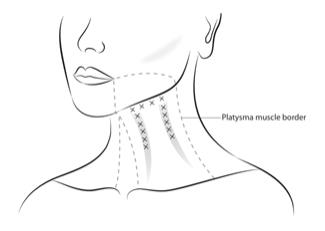 Figure 5: Injection Sites for Platysma Prominence (2 Bands)