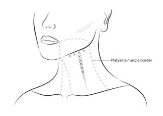 Figure 6: Injection Sites for Platysma Prominence (1 Band)