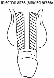 Injection site