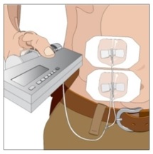 Secure the needle(s) in place by applying a sterile protective dressing over the site.