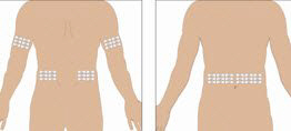 Select the number of infusion sites based on the volume of the total dose. It is recommended that you not inject more than 20 mL for children and 30 mL for adults into each infusion site.