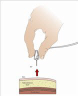 After the infusion is complete, remove the needle set by pulling it straight out. Gently press a small piece of gauze over the needle site and cover with a protective dressing