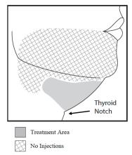 Figure 1.  Avoid the Marginal Mandibular Nerve Area