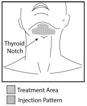 Figure 3. Injection Pattern