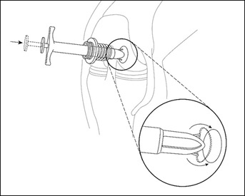 Arthroscopic Delivery