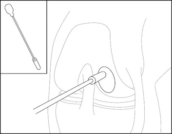 Placement of Implant